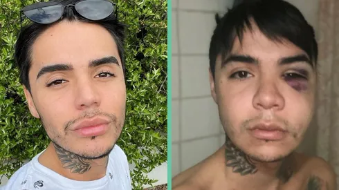 El antes y del después de la bichectomía de Leo Méndez Jr.
