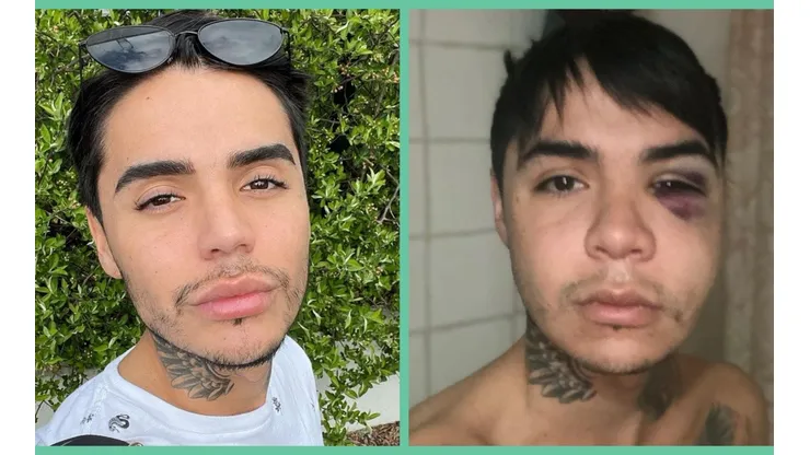 El antes y del después de la bichectomía de Leo Méndez Jr.