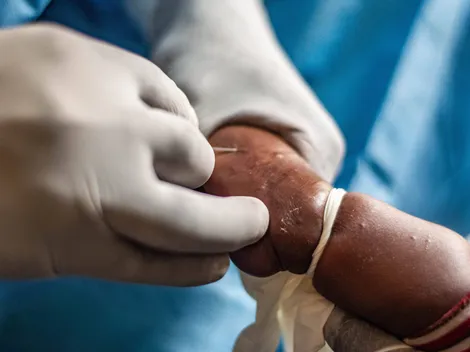 ¿Cómo se contagia la Viruela del Mono? Esto dice el Minsal