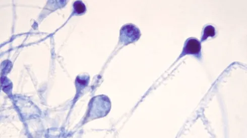 Casi 9.000 casos de Hongo Negro o mucormicosis se registraron en India sólo durante esta semana.