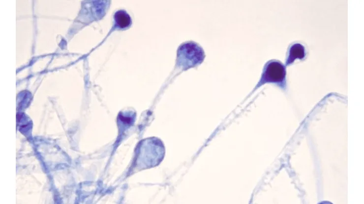 Casi 9.000 casos de Hongo Negro o mucormicosis se registraron en India sólo durante esta semana.