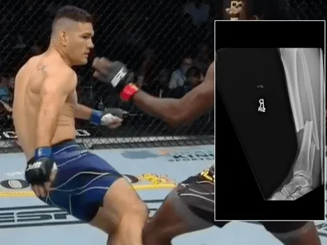 UFC: Weidman revela fotos de su cirugía tras terrible fractura