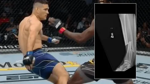 Weidman sufrió la fractura de su pierna tras una patada ante Hall