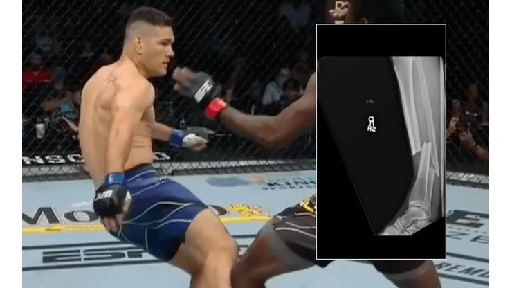 Weidman sufrió la fractura de su pierna tras una patada ante Hall