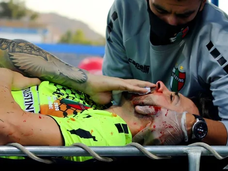 Arquero de Palestino será operado por múltiples fracturas