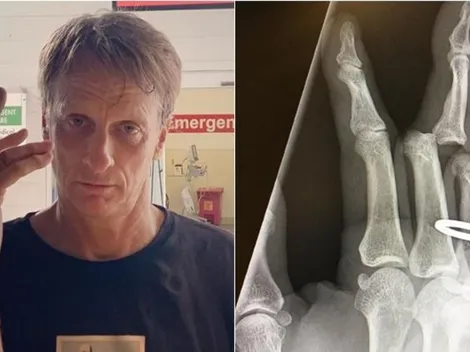 Tony Hawk revela radiografías de sus dedos dislocados en accidente