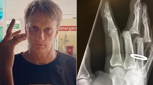 El legendario patinador narró el accidente que sufrió mientras entrenaba con su hijo y amigos en una piscina vacía, donde terminó con dos dedos dislocados