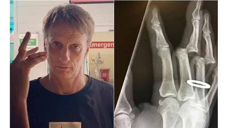El legendario patinador narró el accidente que sufrió mientras entrenaba con su hijo y amigos en una piscina vacía, donde terminó con dos dedos dislocados