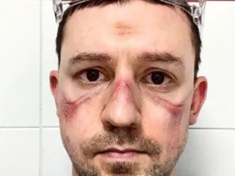 Enfermeros italianos impactan al mundo con selfies de sus rostros heridos