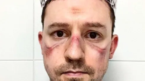 Enfermeros italianos impactan al mundo con selfies de sus rostros heridos