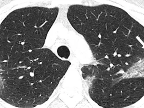 [Video] Así se ven los pulmones afectados por Coronavirus