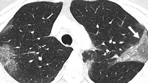[Video] Así se ven los pulmones afectados por Coronavirus