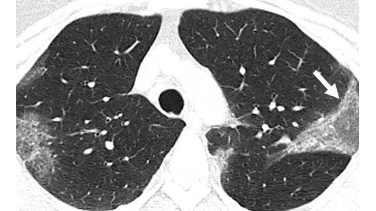 [Video] Así se ven los pulmones afectados por Coronavirus