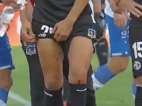 Blandi sale herido por explosión de artificio