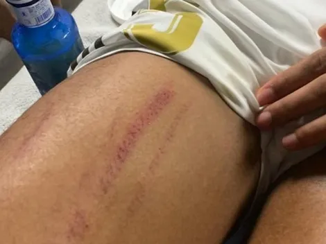 Publican imagen del muslo de Varane tras supuesto penal en el clásico