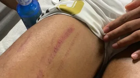 Publican imagen del muslo de Raphael Varane tras supuesto penal en el clásico