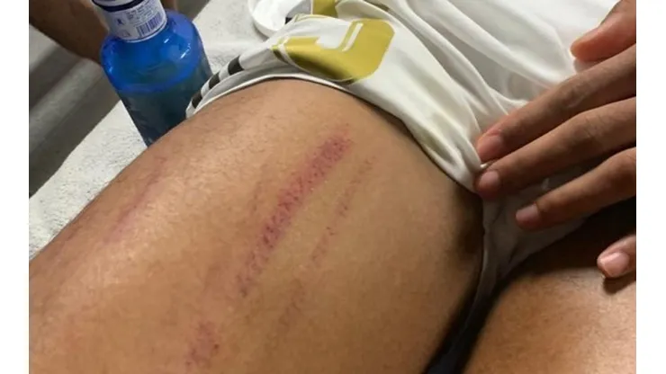 Publican imagen del muslo de Raphael Varane tras supuesto penal en el clásico