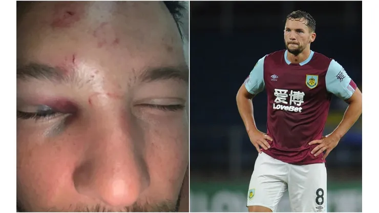 El rostro desfigurado de Drinkwater fue portada este domingo en la prensa inglesa