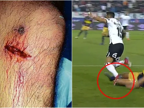 Increíble lesión de Bastián San Juan: De la Fuente le clavó un estoperol en la rodilla