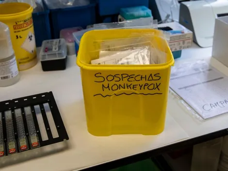 ¿Cuáles son los síntomas y qué tengo que hacer si creo que tengo la Viruela del mono?