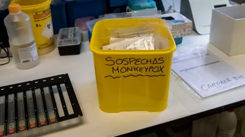 ¿Qué tengo que hacer si creo que tengo la Viruela del mono?