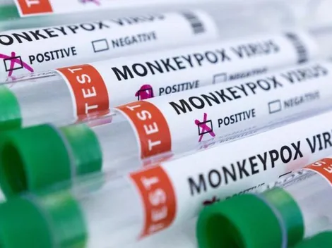 Primer caso de Viruela del mono en Chile | ¿Cuáles son los síntomas?