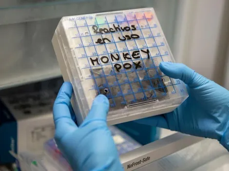 ¡Viruela del Mono ya llegó a Chile! Minsal confirma primer caso en la RM