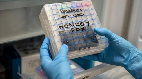 ¡Viruela del Mono ya llegó a Chile! Minsal confirma primer caso en la RM