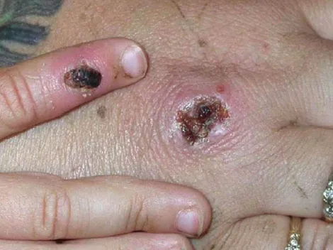 ¿Cómo se contagia la viruela del mono?