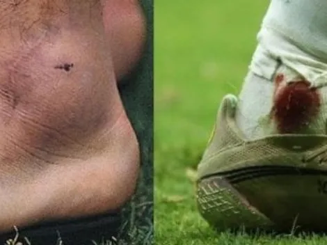 Tobillo ensangrentado de Messi recuerda al de Maradona en 1990
