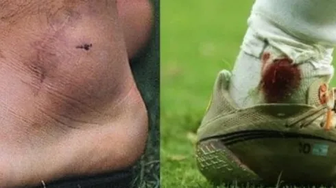 El tobillo de Maradona a la izquierda en Italia 90. Al lado, el de Messi ante Colombia.