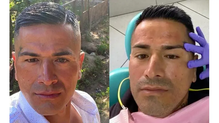 Kike Acuña se aplicó botox para rejuvenecer