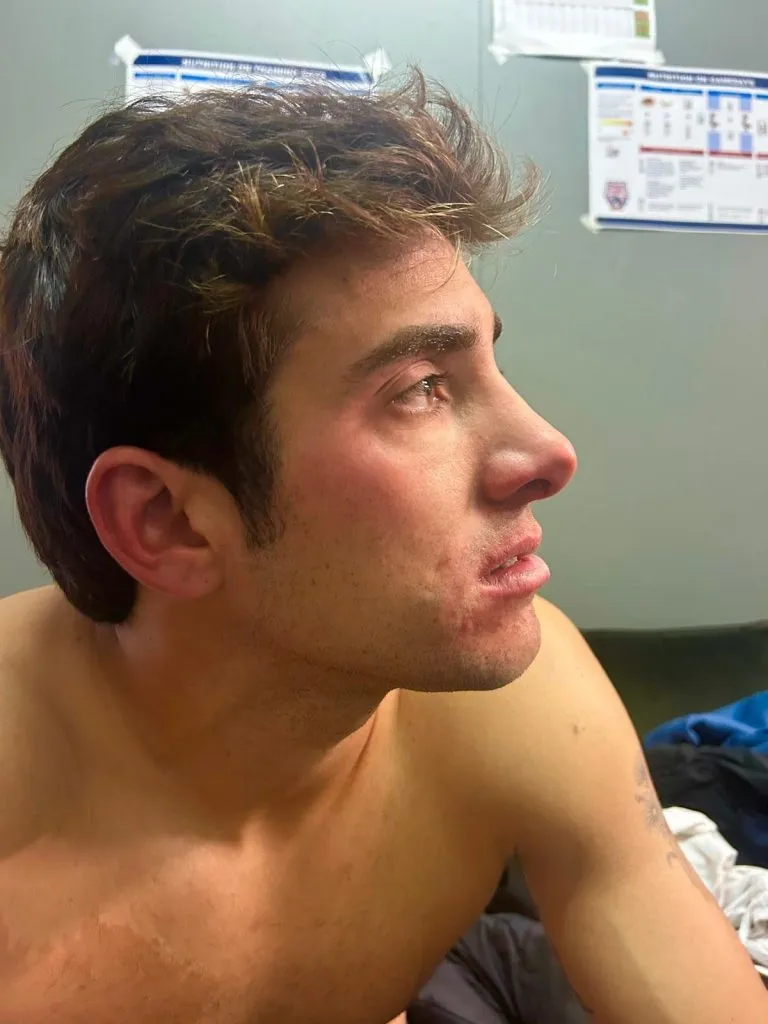 Así quedó Cristian Garin tras la agresión. Imagen: Equipo de Chile de Copa Davis.