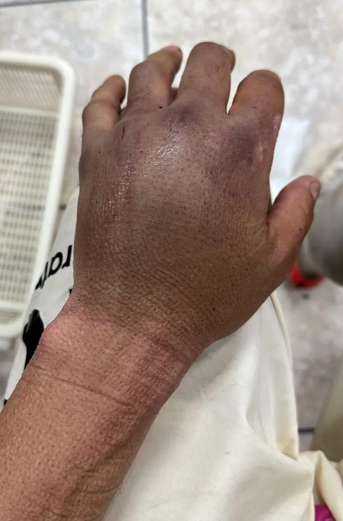 Así quedó la mano de Rodrigo Ureña tras recibir un fuerte pisotón en Perú. | Foto:  Jean Ferrari.