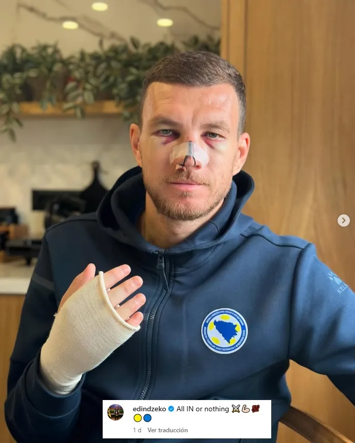 Edin Dzeko muestra cómo le quedó la cara en Instagram.