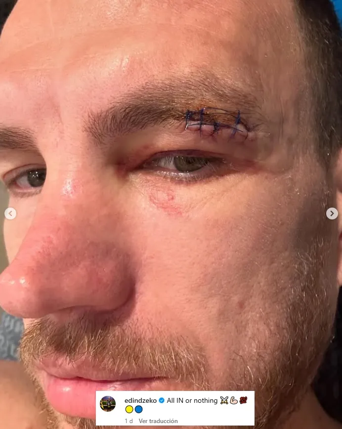 Edin Dzeko muestra cómo le quedó la cara en Instagram.