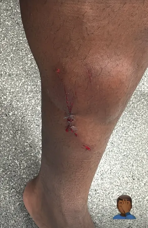 Así quedó la pierna de Helinho tras el tremendo planchazo de Igor Lichnovsky. Foto: Instagram.