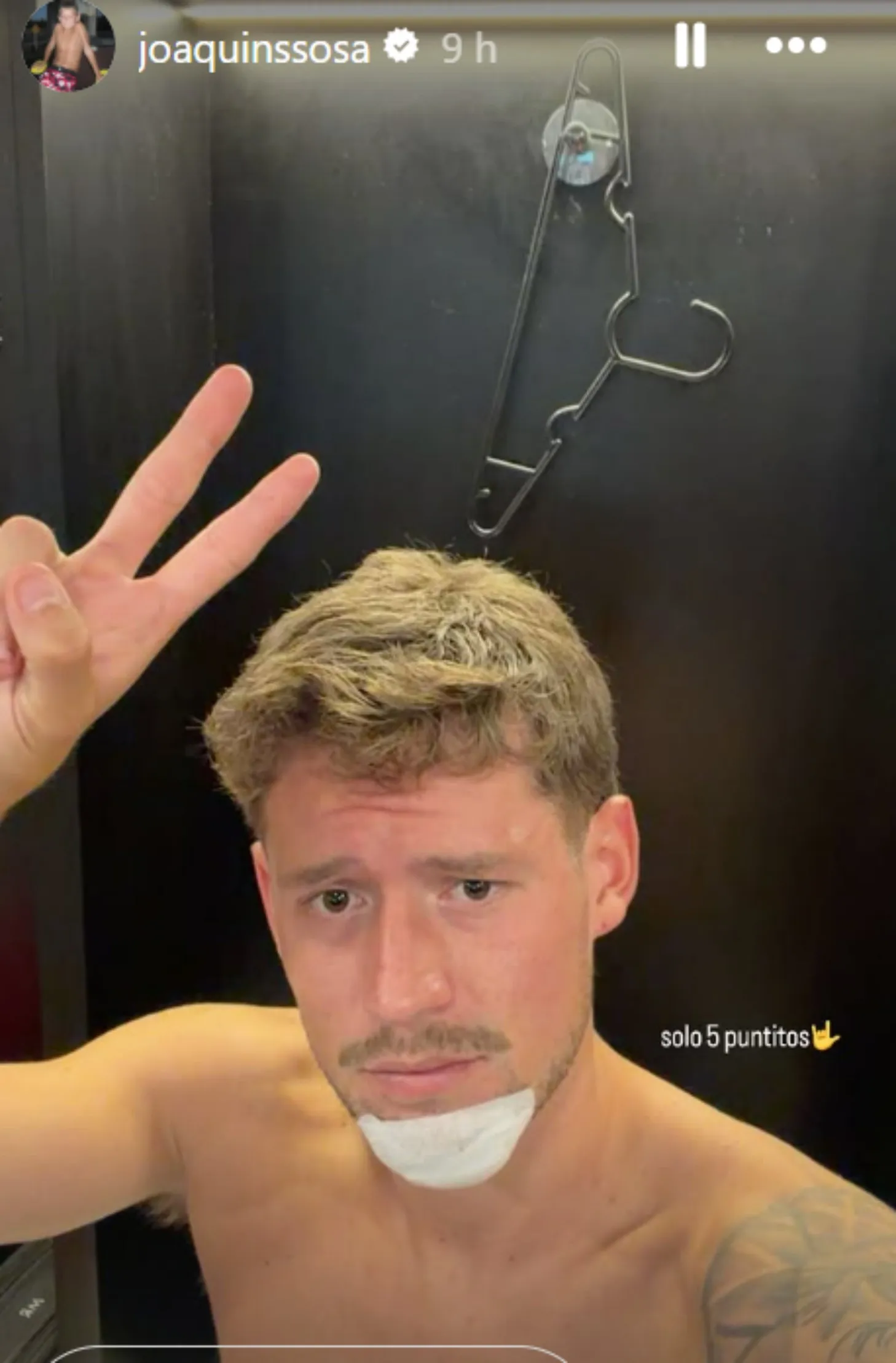 Cocoliso Sosa mostró su “herida de guerra”