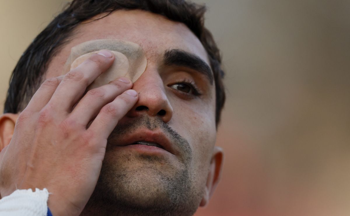 La lesión ocular de Nicolás Ramírez en U de Chile: “Todavía tiene la marca”