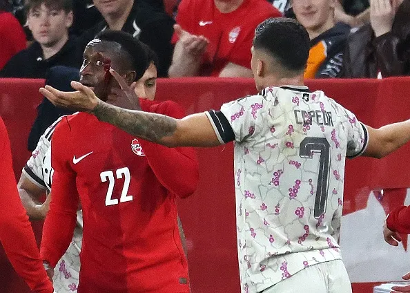 Así quedó Richie Laryea tras el golpe de Lucas Cepeda. (Steve Russell/Toronto Star via Getty Images).